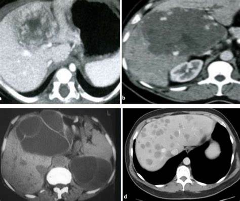 Киста в печени диета лечение Киста печени на КТ - как выглядит киста печени на томографии Киста печени на КТ - как выглядит киста печени на томографии Киста в печени диета лечение
