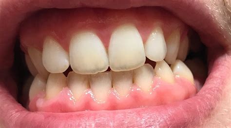 Front Teeth Are Looking Translucent And Are Sensitive Dentistry