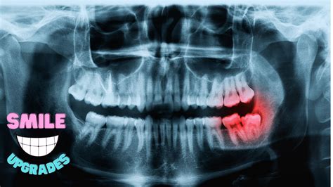 What Do Wisdom Teeth Stitches Look Like Types And Care Guide