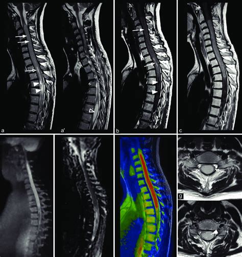 Spinal Cord Mri Of A Young Patient Affected By An Extensive