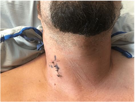 Anterior View Of Patients Neck The Day After Surgery Right Before