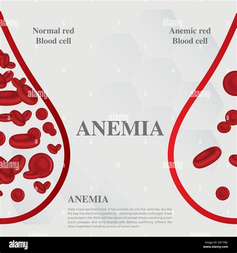 Anémie Quantité De Sang Rouge Carence En Fer Anémie Différence Danémie