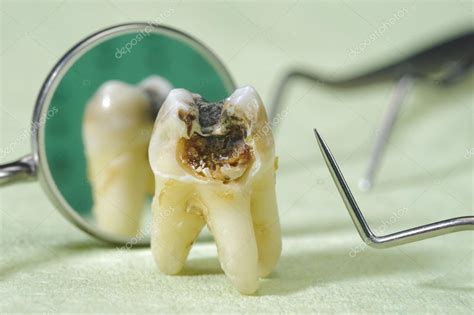 Tooth With Dental Caries — Stock Photo © Filmfoto 26490243