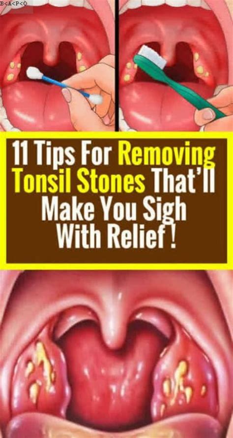 Tonsillitis Tonsil Stones