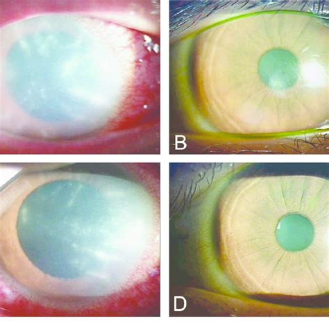 Clinical Appearance Of Acanthamoeba Keratitis Patient Associated With