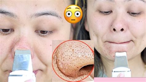 remove blackheads cleanse and lift with agaro ultrasonic facial skin scrubber youtube