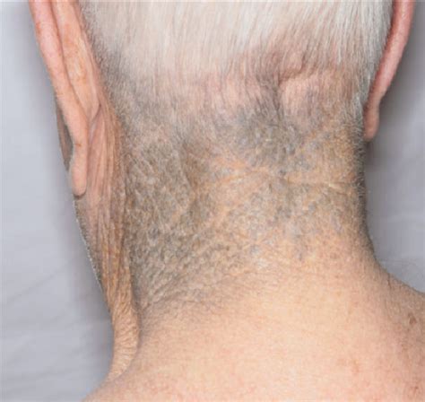 Figure 2 From Minocycline Induced Cutaneous Hyperpigmentation In An