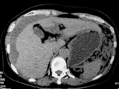 Vietnamese Medic Ultrasound Case 332 Peritoneal Carcinomatosis Dr