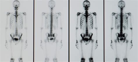 Scintigraphy Allows Doctors To See Changes And Abnormalities Inside Your Bones