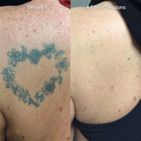 Vol 2 Best Of 2021 Before And After Tattoo Removal Results Removery