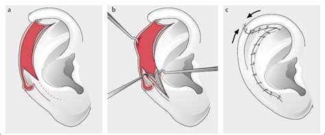 The Auricular Region Plastic Surgery Key