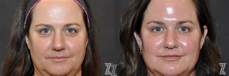 Injectable Fillers Before And After Photos Patient 316 Austin Tx The