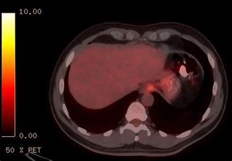 Stomach Cancer Ct Wikidoc