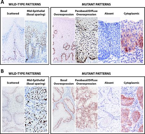 Major P Immunohistochemical Patterns In Vulvar Squamous Lesions A In Download Scientific