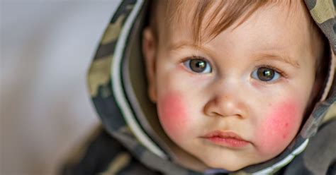 Dermatita Atopic Bebelu I I Copii Cauze Simptome I Tratament