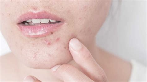 Skincare For Acne Prone Skin
