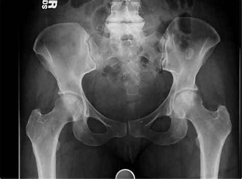 Plain Ap Pelvis X Ray At 5 Years Follow Up Of A Patient With A Stage