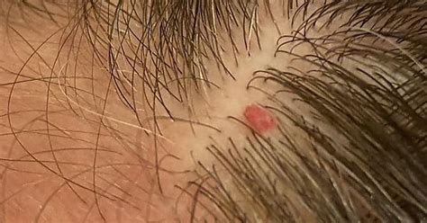 Is This Just A Cherry Angioma Imgur
