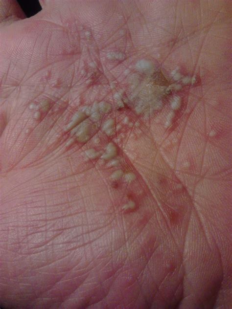 Common symptoms can include a. I have crohns and I usually get blisters on my hands every