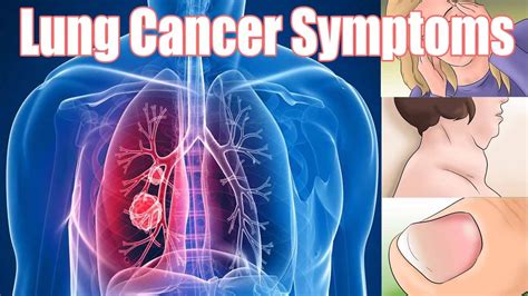 lung cancer signs and symptoms