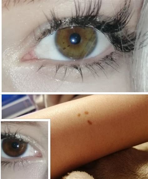 I Have Matching Triangle Freckles On My Arm And My Left Eye R