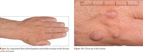 Bilateral Agminated Skin Colored Papules And Nodules On The Dorsum Of