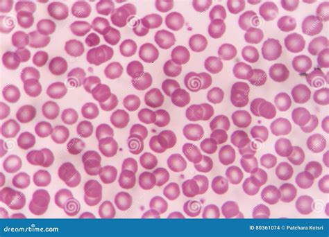 Blood Smear Stock Photo Image Of Therapy Test Medicine 80361074