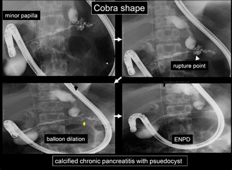 Endoscopic Treatment Of Pancreatic Diseases Via Duodenal Minor Papilla
