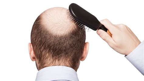 Cure For Male Baldness With No Sexual Side Effects Israel21c