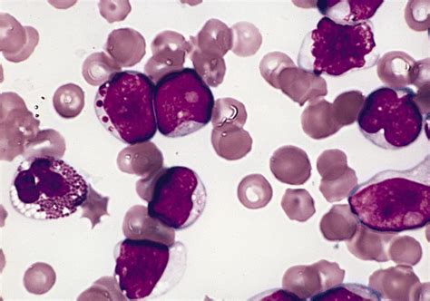 Pathology Outlines Acute Basophilic Leukemia