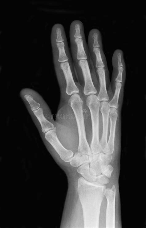 Right Hand X Ray Royalty Free Stock Image Image 23545536