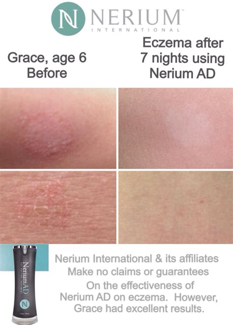My Daughters Results With Nerium Ad On Her Eczema Try It And See