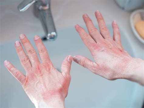 ¿por Qué Puedes Tener Dermatitis De Contacto