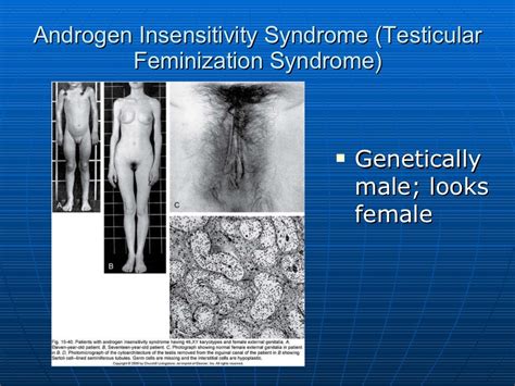 Androgen Insensitivity Syndrome Testicular Feminization