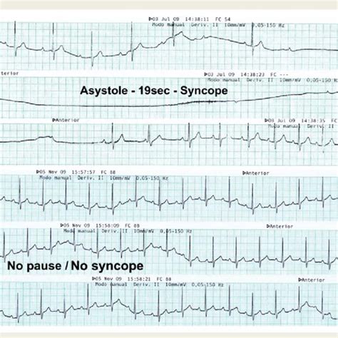 Typical Example Of Pre And Post Ablation Head Up Tilt Test In This