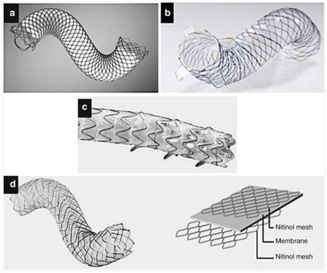 Self Expandable Metal Stents Biomaterials And The Fibrotic Tissue