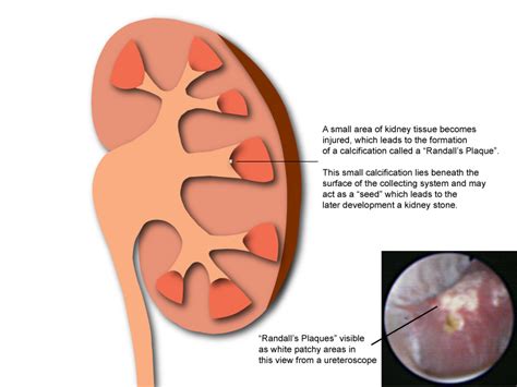 How Do Kidney Stones Form
