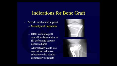Bone Grafting 3 Indications For Bone Graft Ota Lecture Series Iii