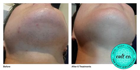 So in case you've ever wondered what to expect from ipl (and fyi it's not laser) then this video is for you. IPL-hair-removal-before-after-3 | The Cult Collective