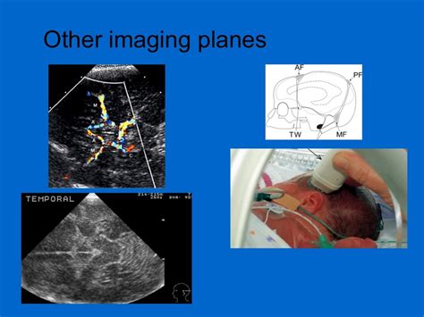 Neonatal Transcranial Ultrasound
