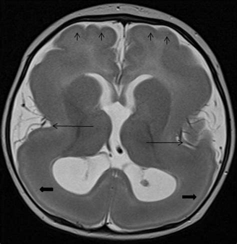 Tuba1a Mutation Associated Lissencephaly Case Report And Review Of The