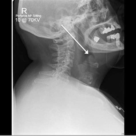 Neck Radiograph Indicating Epiglottitis Download Scientific Diagram