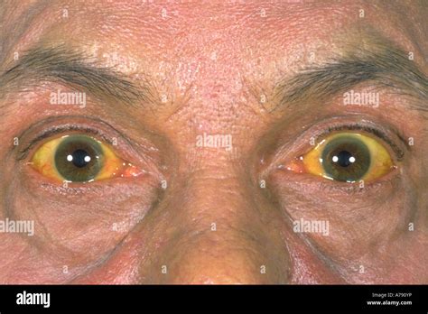 Yellowing Of Sclera Of Eye Due To Jaundice Photograph By