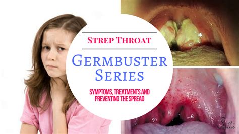 Strep Throat Signs Symptoms And Treatments Signs Of Strep Throat