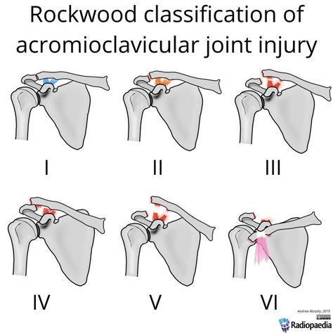 Acromioclavicular Joint Separation Treatment
