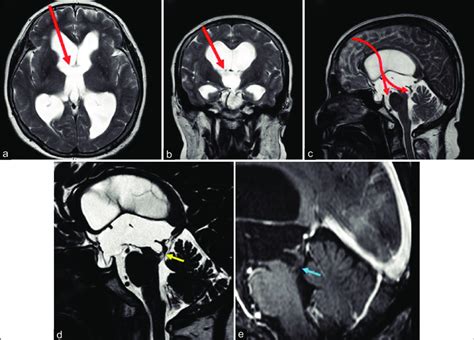 Magnetic Resonance Imaging Pretreatment Findings A C T2wi Showed