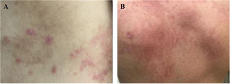 Frontiers Adult Onset Stills Disease A Disease At The Crossroad Of