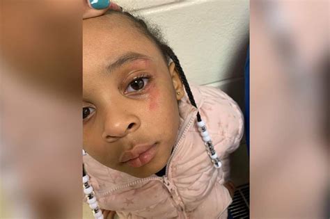 Mom Furious After Teacher Hits Kindergartner In The Face With Ruler