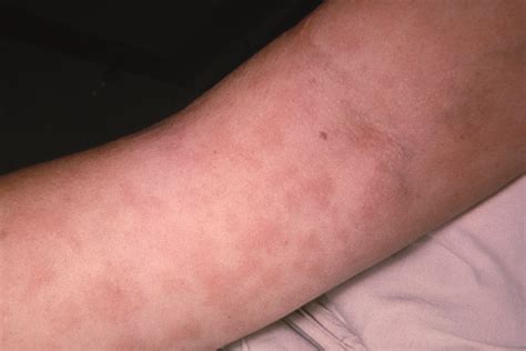 Penicillin Allergy Often Inaccurately Recorded By Healthcare