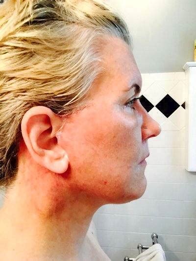 Lower Facelift Scars 19 Facelift Info Prices Photos Reviews Qanda